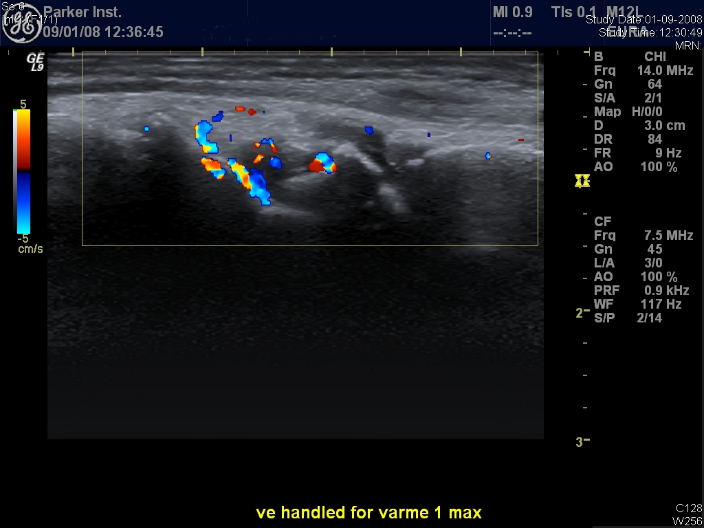 ultrasound image of hand with rheumatism